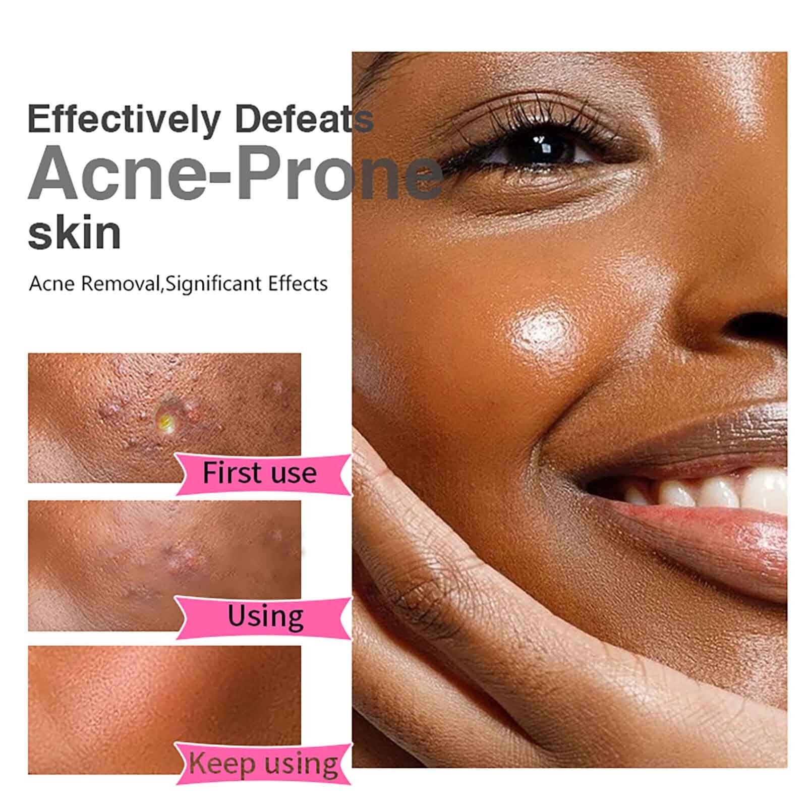 Organic Salicylic Acid Acne Cream Skin EMJP TRENDS